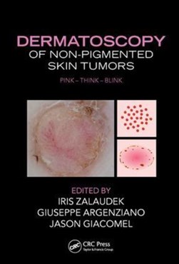 Dermatoscopy of non-pigmented skin tumors by Iris Zalaudek